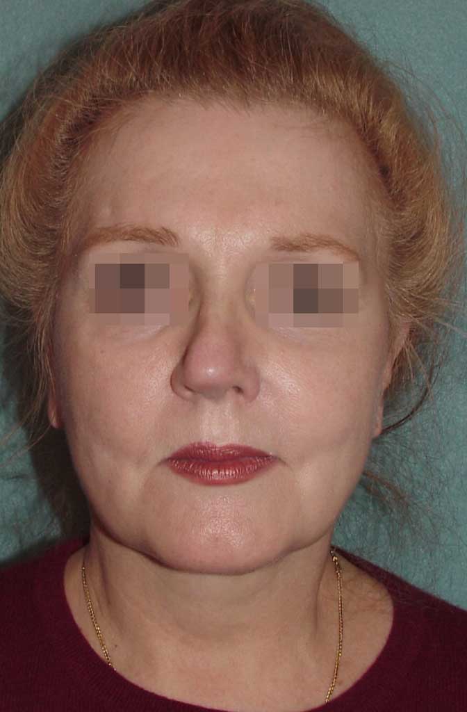 Neck Lift 1 - Robert A. Guida, Md, Pc